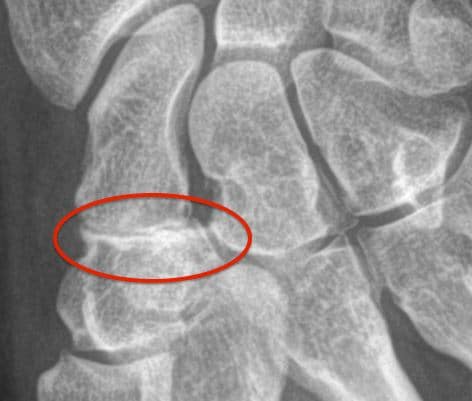 Douleurs articulaires Arthrose, fracture
