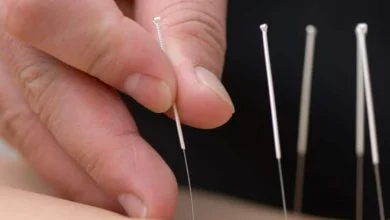 Acupuncture