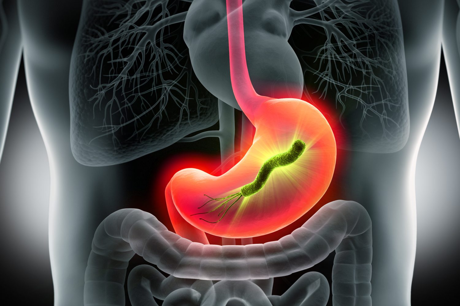 Helicobacter pylori dans l estomac