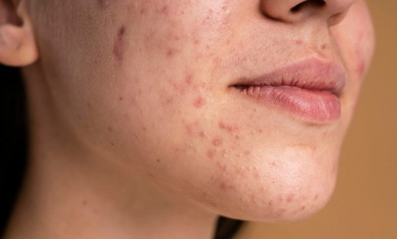 Visage de femme avec des boutons