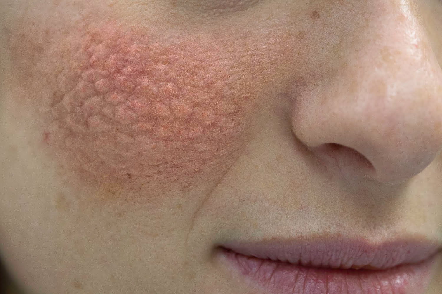 Lupus : Vivre mieux au quotidien grâce à des approches naturelles et un mode de vie adapté