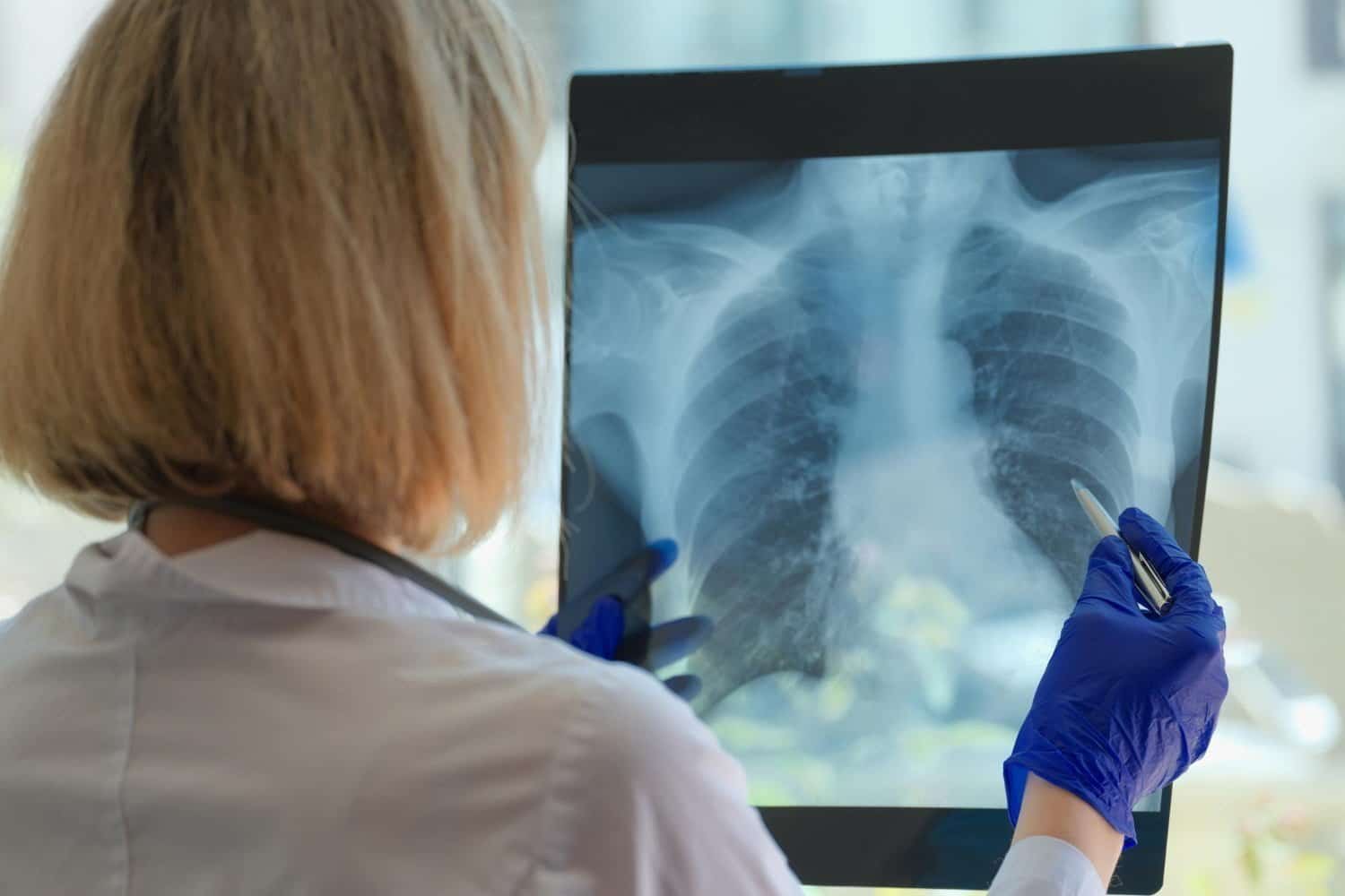 comment meurt-on d'un cancer de la plèvre