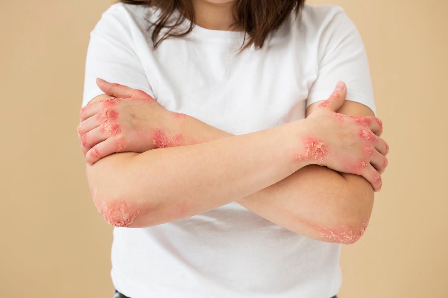 Psoriasis : causes et traitements en 10 points