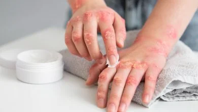 Main qui met de la creme pour soigner un eczéma