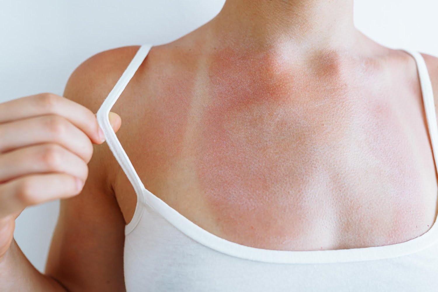 Le coup de soleil phénomène de guérison à éviter au maximum