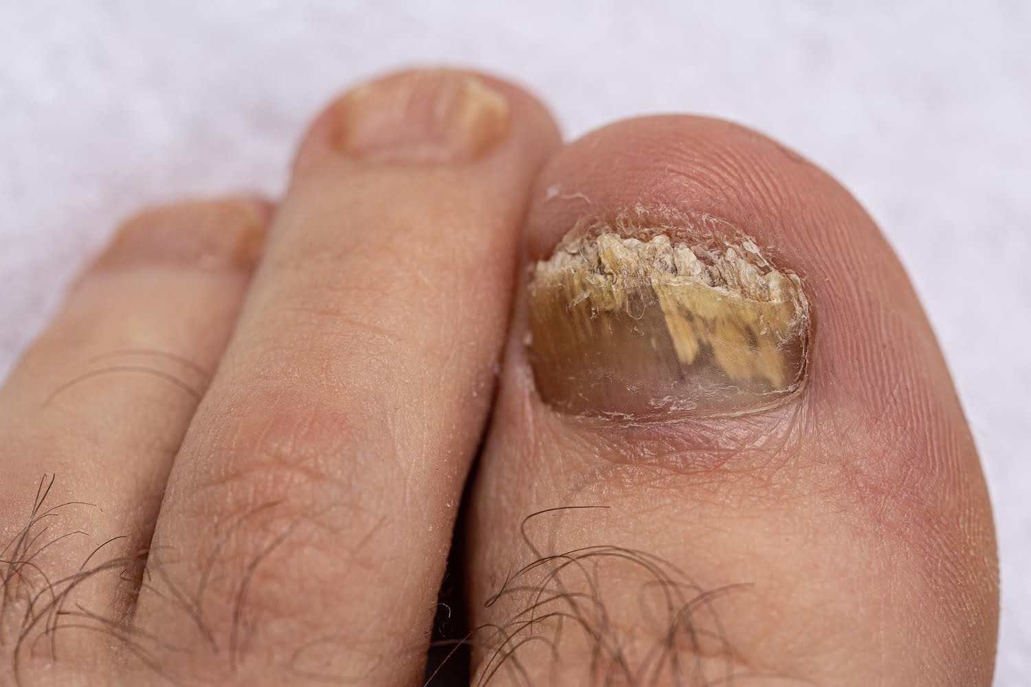 Grzybica paznokci: przyczyny, leczenie i zapobieganie.