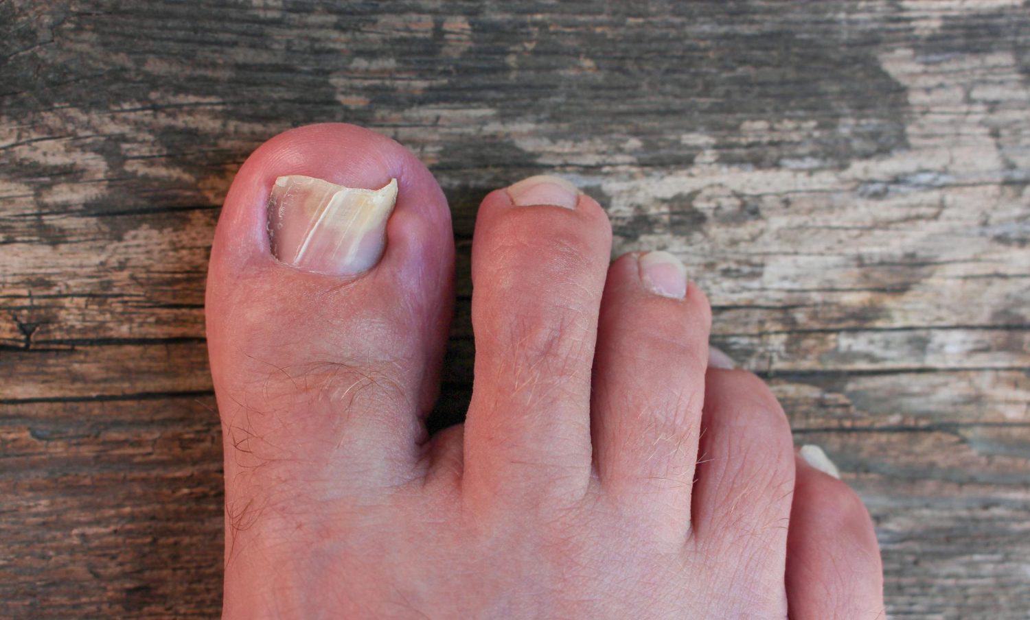 Ongles de pieds abimé