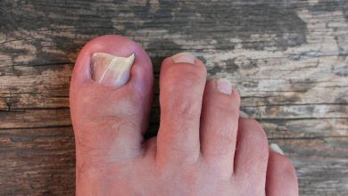 Ongles de pieds abimé