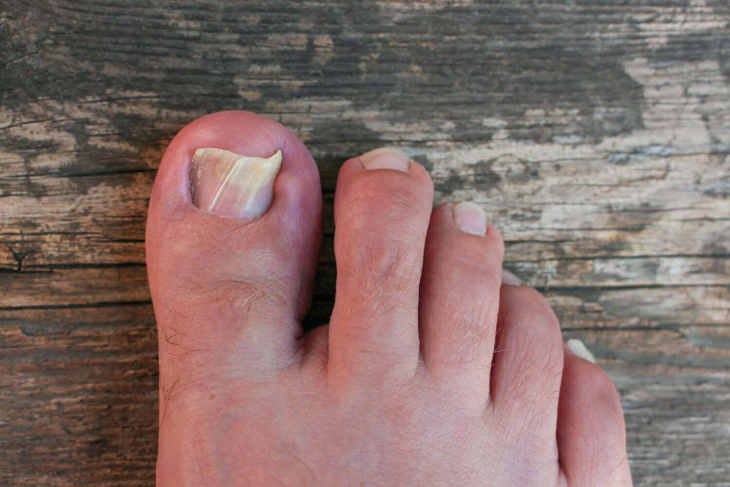 Ongles de pieds abimé