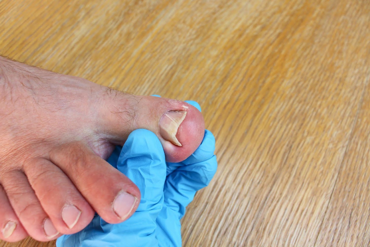 Photo pied d' un homme avec un ongles recourbé